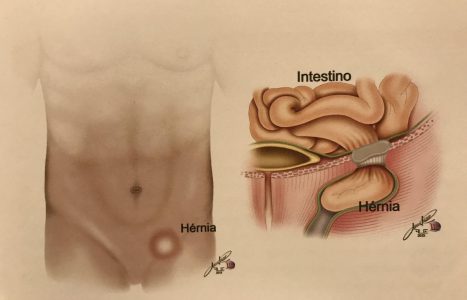 Cirurgia Hérnia Umbilical - IZB Gastro