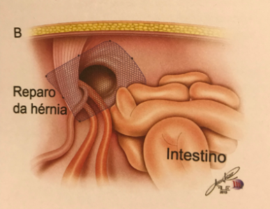 hérnias abdominais inguinais e umbilicais - Leonardo Ferraz